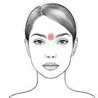 Face Treatment - Glabella Illustration