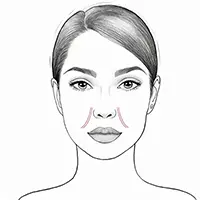 Face Treatment - Nasolabial Folds Illustration