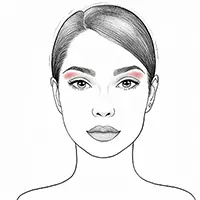Face Treatment - Upper Eyelid Illustration